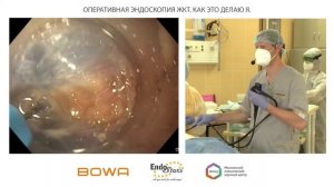 Оперативная эндоскопия ЖКТ. Дивертикул Ценкера. О. Б. Ткаченко, И. Ю. Недолужко, К. В. Шишин