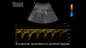 Фибромускулярная дисплазия, стеноз правой почечной артерии