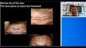 Botox Training - Injecting Forehead Properly - (858) 905-5780