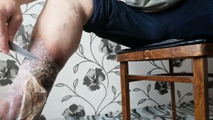 Tрофическая язва.Чистка ноги трофическая язва при варикозе.