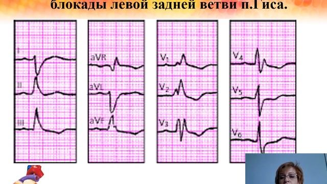 Экг блокады тест. Блокады на ЭКГ. Блокады на ЭКГ фото. Блокады на ЭКГ расшифровка. Синдром предвозбуждения желудочков на ЭКГ.