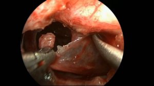 Эндоскопическое удаление краниофарингиомы (18+)