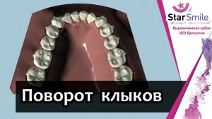 Смещение зубов при ротации. Разворот клыков элайнерами Star Smile