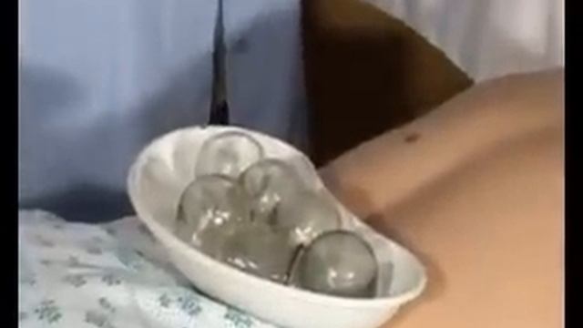 Використання медичних банок смотреть онлайн