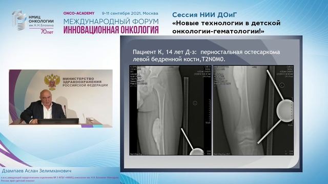 Эндопротезирование в детской онокологии. смотреть онлайн