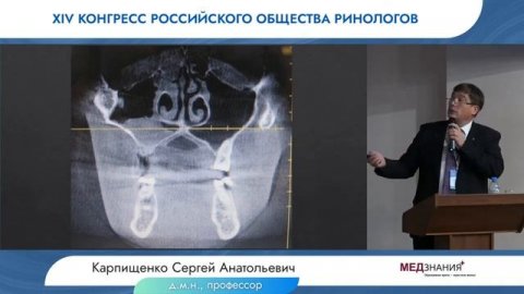 Сложные пазухи трудные пациенты