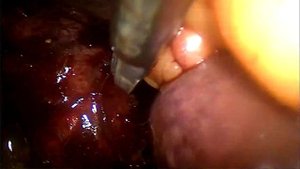 Лапароскопическая субтотальная холецистэктомия | Laparoscopic subtotal cholecistectomy