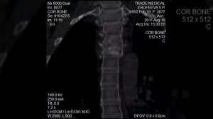 Кт грудного отдела позвоночника
