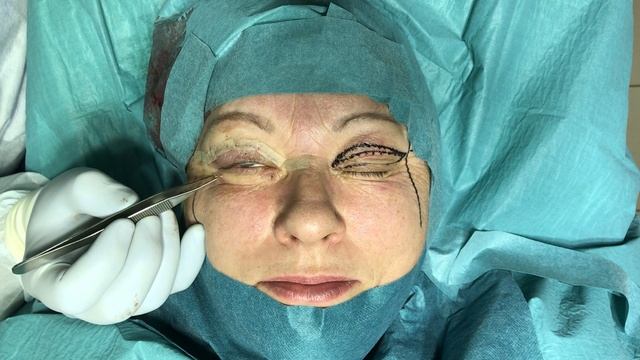 Пластический хирург Константин Клименко. Блефаропластика верхних век.