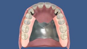 Протезирование Бюгельный верхний протез с кламерной фиксацией