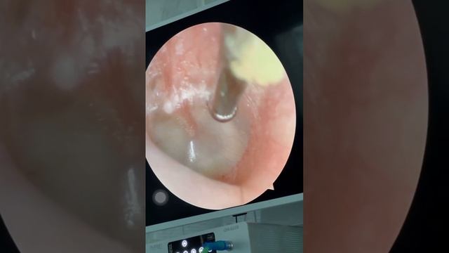 Парацентез барабанная перепонка смотреть онлайн