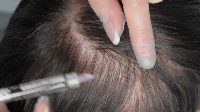 Мастер-класс на препарате PLINEST fast для решения трихологических проблем смотреть онлайн