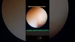 ПОЛИП МАТКИ в правом маточном роге.