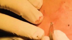 Прыщи на спине! Выдавливание прыщей,выдавливание черных точек!