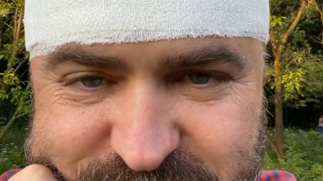 41-летний муж 71-летней Надежды Бабкиной сделал пересадку волос