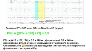 Интервал и сегмент PQ, корригированный PQc , индекс PQs