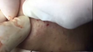 НОВОЕ. Чистка лица от черных точек.