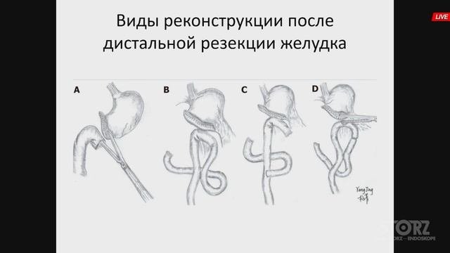 Онкологический радикализм Vs хирургическая безопасность. 4SurgeonsClub