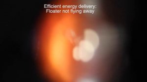 Лазерный витреолизис