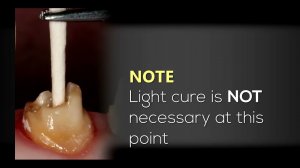Восстановление культи зуба с использованием циркониевого штифта и композитного цемента