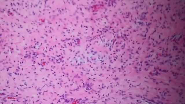 Нейрофиброма смотреть онлайн