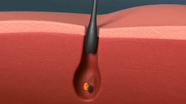 Выпадение волос которое приводит к облысению. Как это происходит под действием гормонов смотреть онлайн