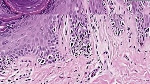 Histopathology Skin--Melanoma in situ