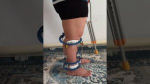 Исправление варусной деформации ног