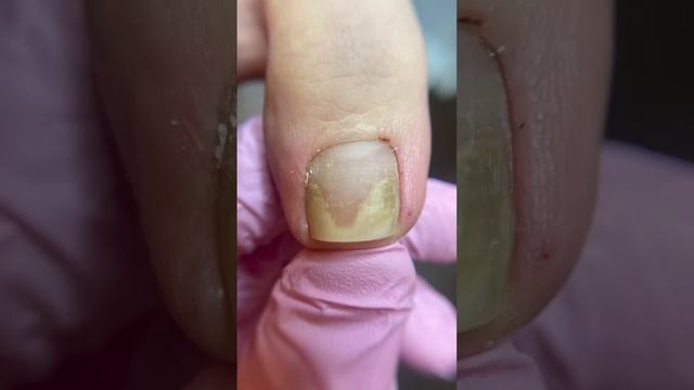 ОНИХОЛИЗИС НОГТЕЙ | MEDPED