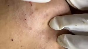 Relaxing Acne Treatment Acnes Treatment  129