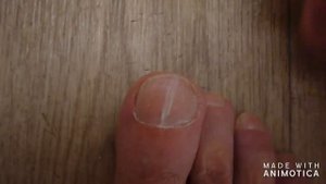 ногти лечение