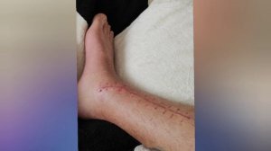 Реабилитация после перелома большеберцовой кости. 4 недели после операции