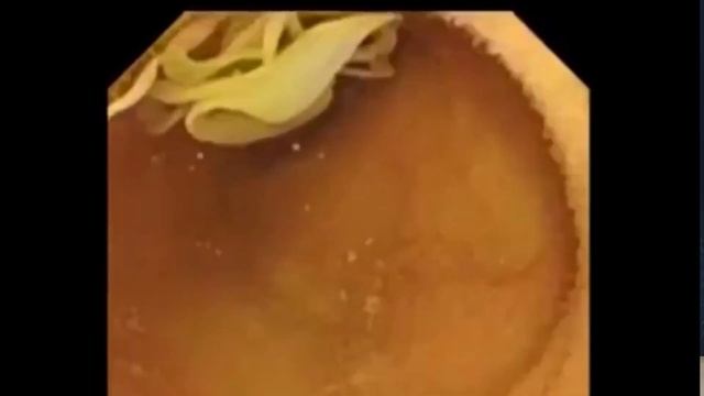 Bachon mein pait kay keeray ll Worms in Children смотреть онлайн