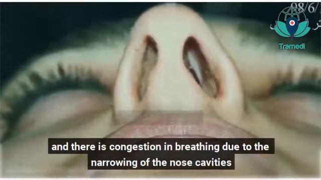 dr omid ebrahimi testimonial rhinoplasty2 смотреть онлайн