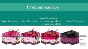 Серия 17. Правила оказания первой помощи при ожогах.
