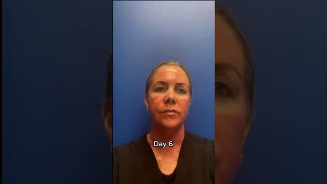 Reno/Tahoe Morpheus+CO2 Laser Healing from Skin Tightening and Resurfacing | Dr. Erez Dayan смотреть онлайн