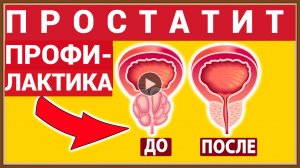 ПРОСТАТИТ - ПРИЧИНЫ ДИАГНОСТИКА ПРОФИЛАКТИКА