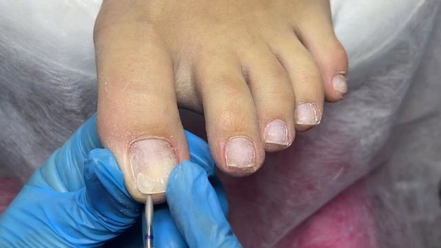 Как убрать подногтевую мозоль ? Ногти плюшки ? Педикюр смотреть онлайн