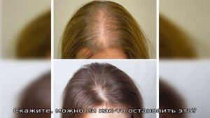 Очень сильно выпадают волосы после рождения ребенка: что делать?