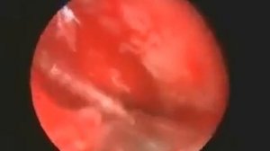 Полипы носа - эндоскопическая полипотомия