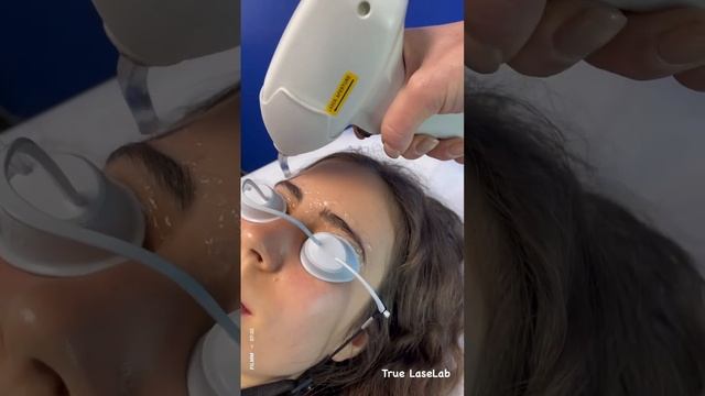 Face laser hair removal with Soprano ICE