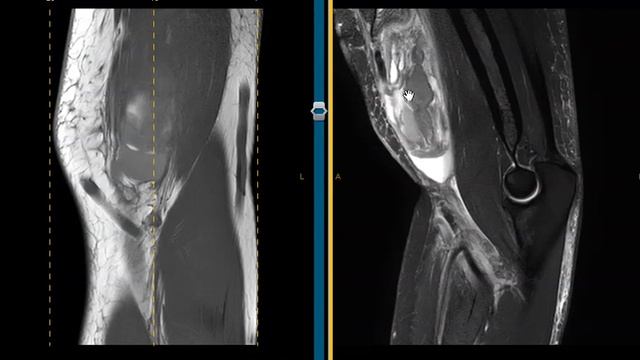 Pain and swelling in arm after tennis смотреть онлайн