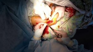 Открытая репозиция чрезмыщелкового перелома плечевой кости