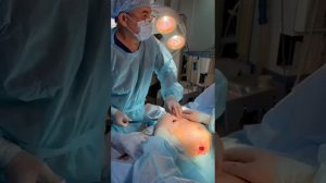 Килевидная деформация грудной клетки. Торакопластика по Г. Абрамсону.