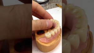 Протез на балочной конструкции