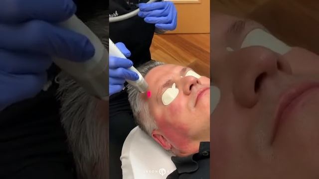 HOW TO IMPROVE REDNESS AND CALM ROSACEA WITH LASER GENESIS MICROSECOND HEATING | Dr. Jason Emer смотреть онлайн