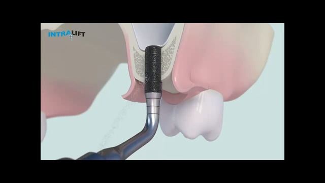 Набор насадок Intralift, Acteon (Satelec) смотреть онлайн