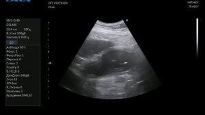 УЗИ желудка хроническая язва