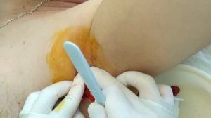 double pimple popping/двойной прыщ(гидраденит)