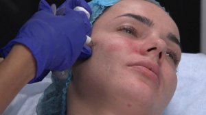 Коррекция средней трети лица формообразующими филлерами PERFECTHA